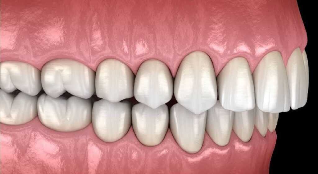 Distal Bite: Causes, Symptoms, and Modern Treatment Methods