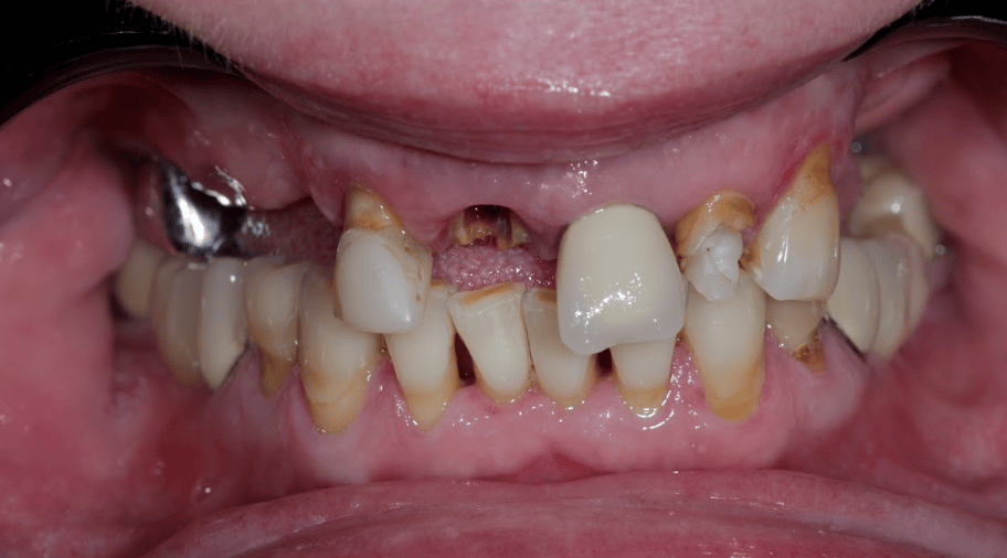6implantu d