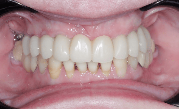 6implantu p