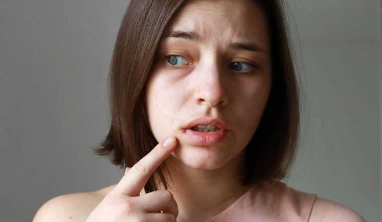 A pimple on the lip