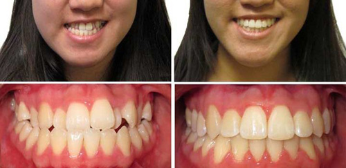 How a Crossbite Looks