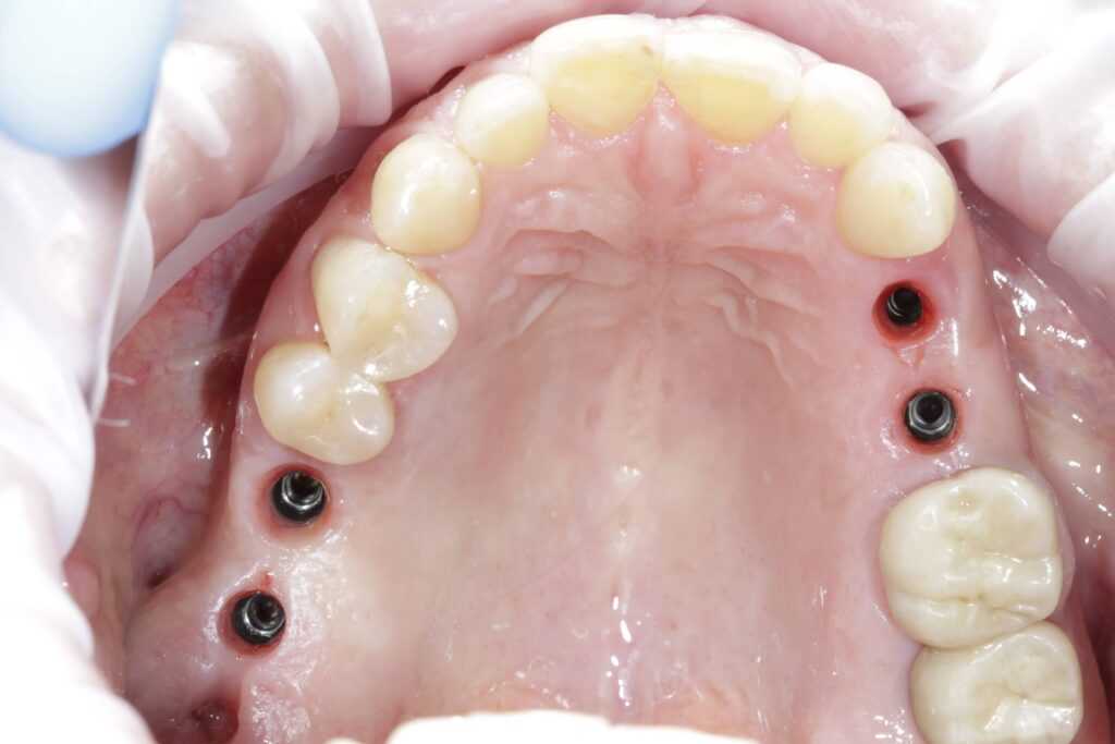 implantu_d
