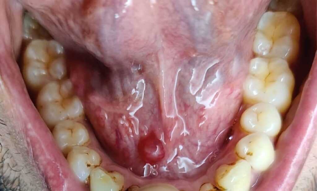 lump under the tongue lump under the tongue