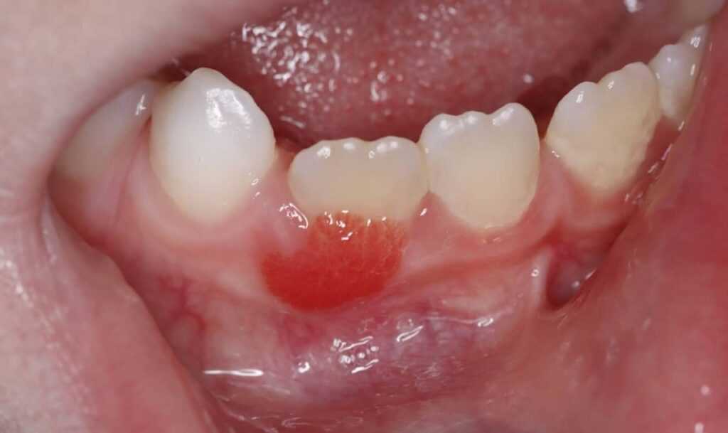 Gingival hyperemia Gum redness