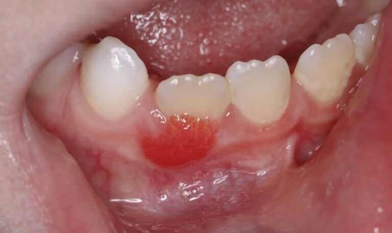 Gingival hyperemia Gum redness Gingival hyperemia Gum redness