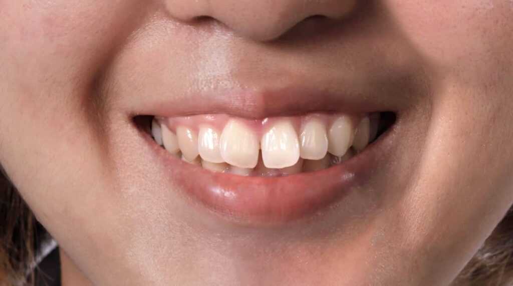 Protrusion of the teeth