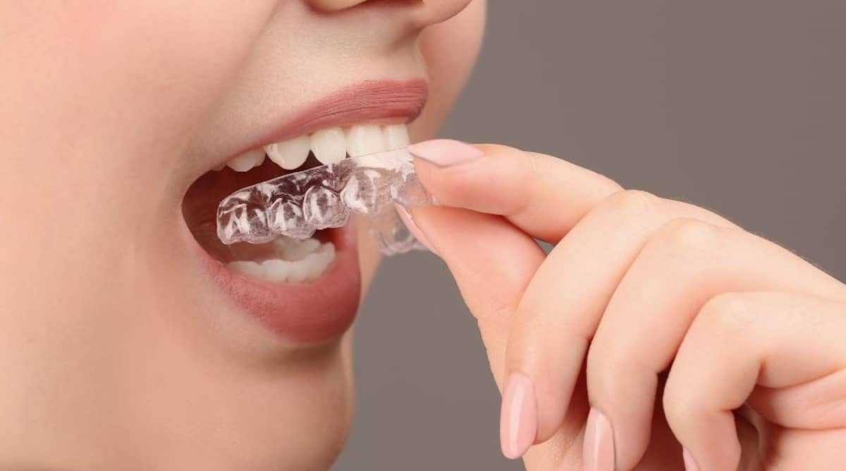 Splint Therapy: What Is a Splint, Who Needs a Joint Mouthguard, and What Affects the Price 2 Splint Therapy