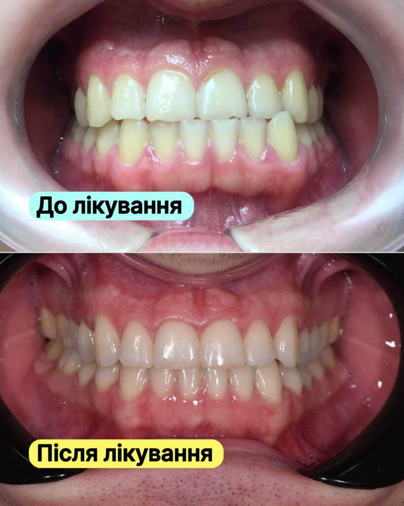 Історія пацієнта <br><span style="color: #2f7cf6; font-weight: 600;">Виправлення прикусу за допомогою брекет-системи Damon Q</span>