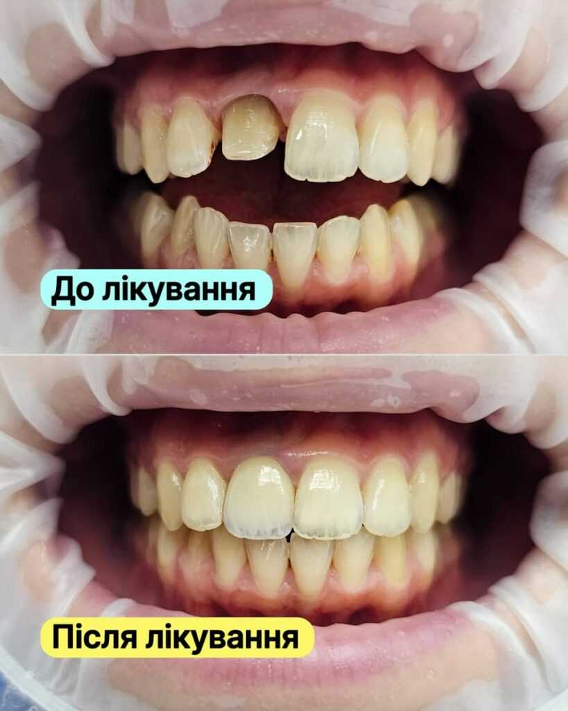 История пациента <br><span style="color: #2f7cf6; font-weight: 600;">🦷 Восстановление эстетики фронтального зуба</span>