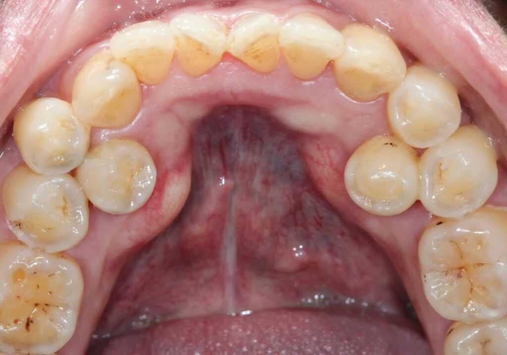 giperdontiya giperdontiya