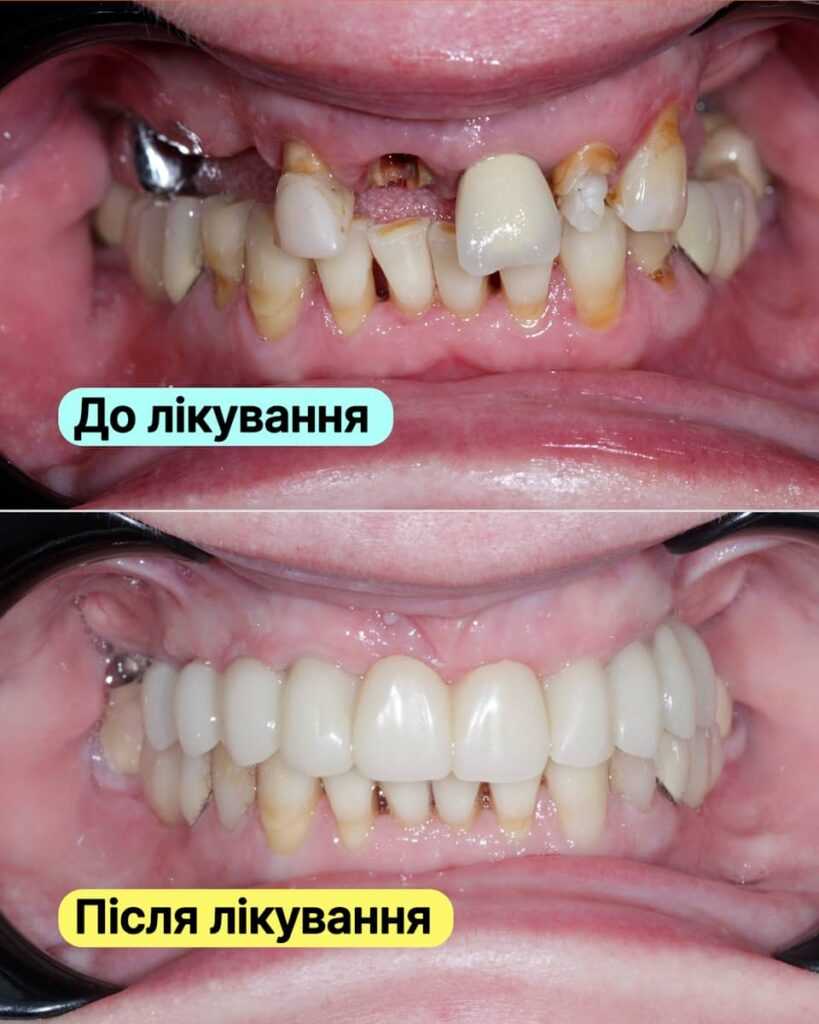 Історія пацієнта <br><span style="color: #2f7cf6; font-weight: 600;">🦷✨ Імплантація зубів за методикою All-on-6</span>