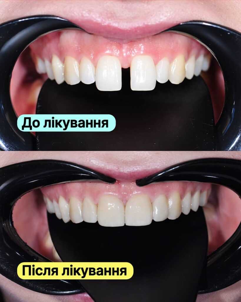 Історія пацієнта <br><span style="color: #2f7cf6; font-weight: 600;">Естетичне перевтілення усмішки вінірами</span>