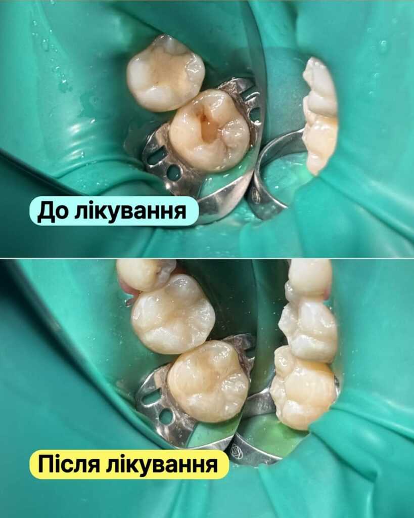 Історія пацієнта <br><span style="color: #2f7cf6; font-weight: 600;">🦷 Лікування вторинного карієсу та заміна старої пломби</span>