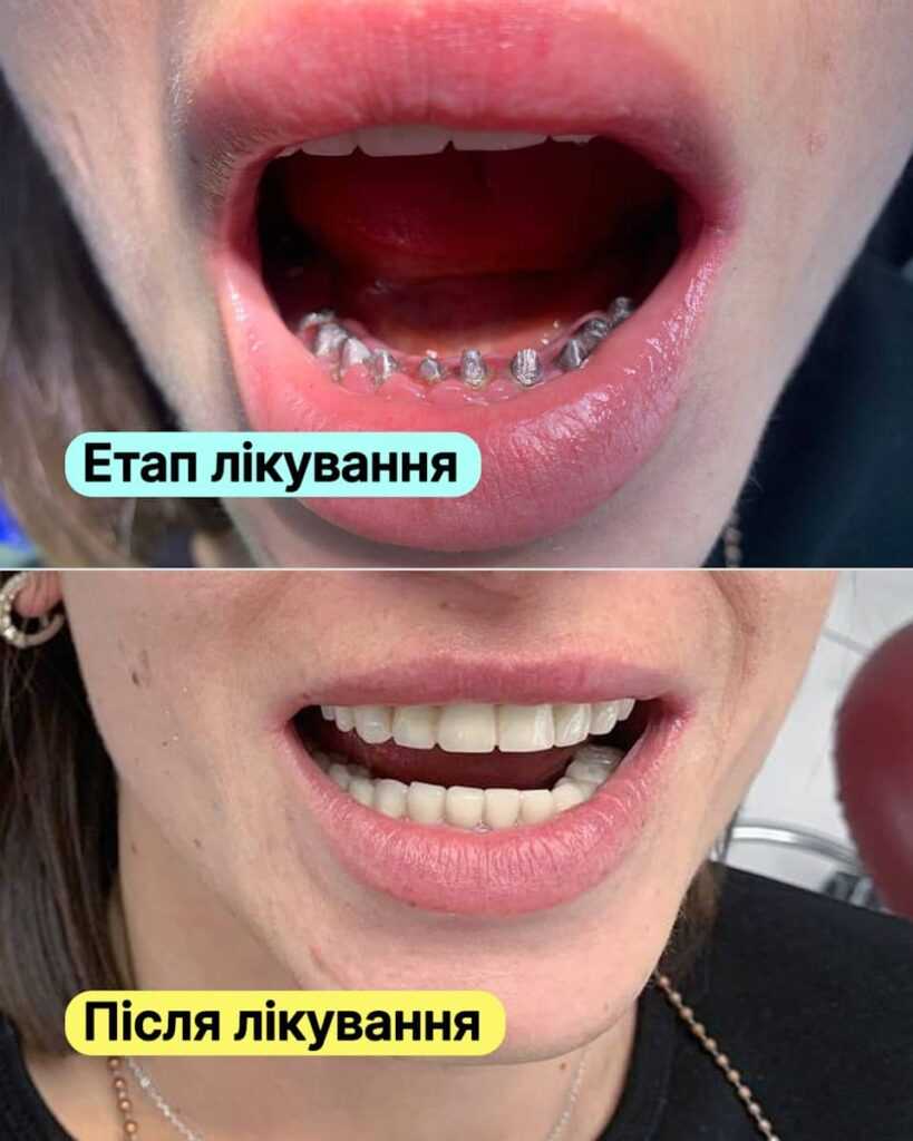 Історія пацієнта <br><span style="color: #2f7cf6; font-weight: 600;">🦷 Тотальне протезування при підвищеній стертості зубів</span>