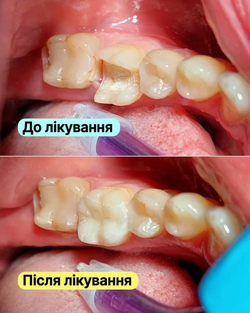Історія пацієнта <br><span style="color: #2f7cf6; font-weight: 600;">🦷✨ Відновлення зуба після ендодонтичного лікування</span>