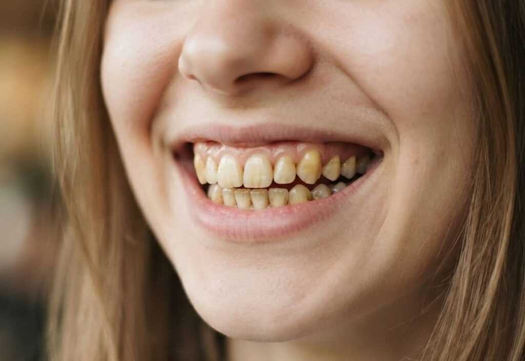 Yellow Teeth: Why Enamel Changes Color and What Adults and Parents Can Do About It 3 Yellow Teeth