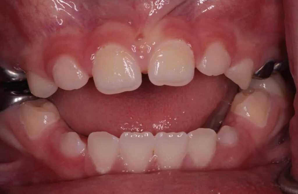 anterior open bite 2 anterior open bite 2