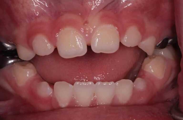 anterior open bite 2 anterior open bite 2
