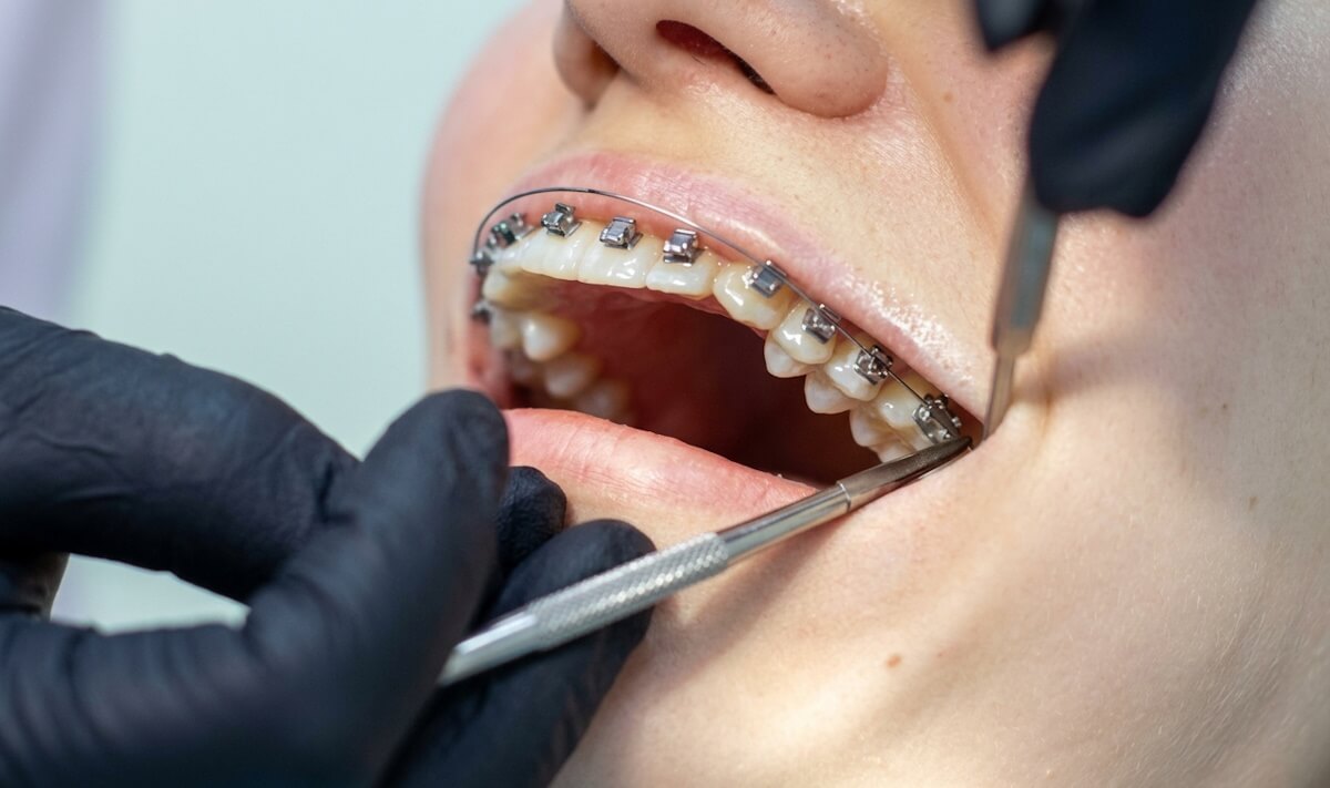 How Braces Are Removed
