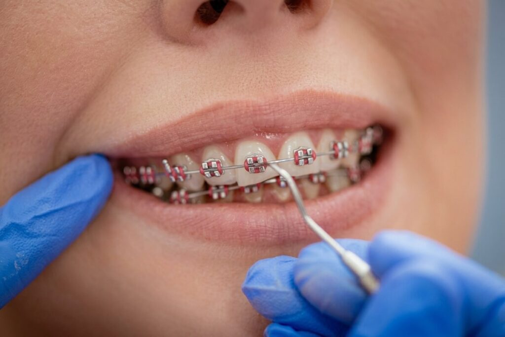 How Braces Are Removed: What Comes Next and How Much It Costs yak znimayut breketi 3